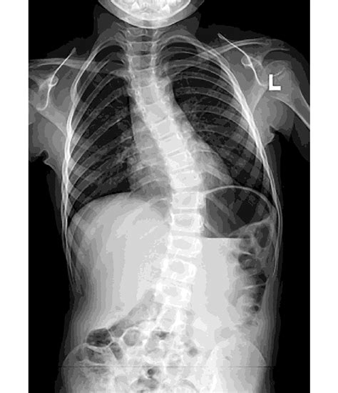 Case 1 Continued The Patient Presented With A Left Thoracolumbar Curve