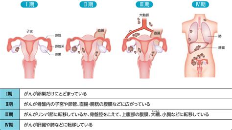 がんの型と広がり 卵巣がんとは Msd Oncology がんを生きる