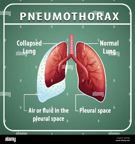 Diagrama de neumotórax con colapso pulmonar e ilustración de pulmón