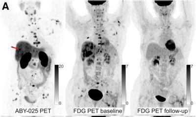 Her Positive Breast Cancer Whole Body Pet Ct Predicts Targeted