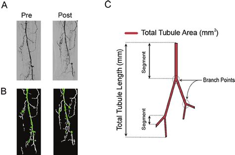 Angiographic Quantification Steps To Assess Neovascularization A