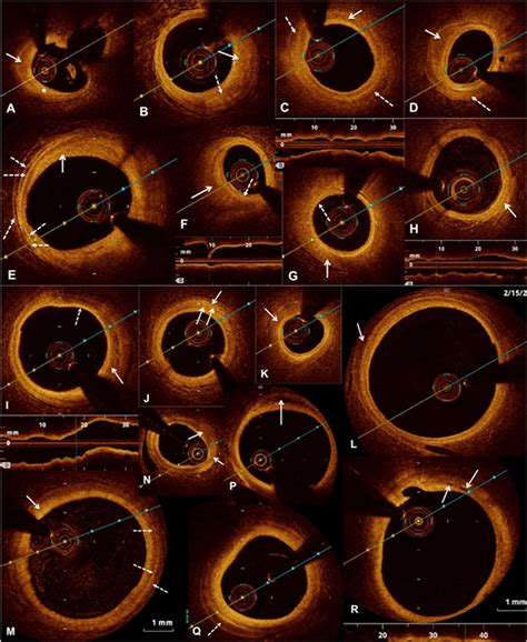 Angiographic And Intracoronary Manifestations Of Coronary Fibromuscular