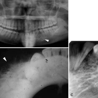 A A Panoramic Radiograph Shows A Multilocular Radiolucent Lesion In