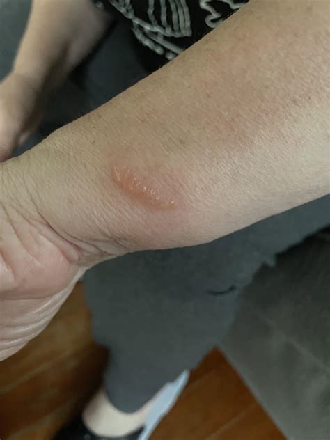 Whats This Rash Rmedicaladvice