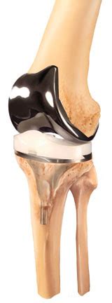 Total Knee Replacement Implants Modern Knee Replacement Techniques