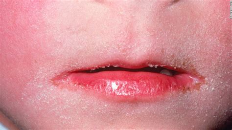 6 [INFO] HOW TO TREAT SCARLET FEVER RASH [CORONA VIRUS] - CORONA