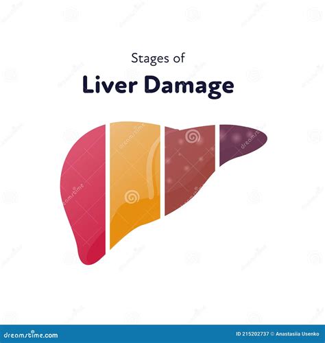 Liver Damage Infographic Vector Flat Illustration Anatomical Human