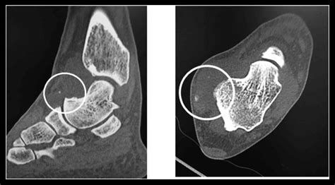 Intra Articular Synovial Sarcoma In The Ankle Joint A Case Report