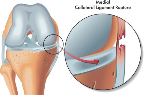 Lcm Ligamento Colateral Medial Instituto Do Joelho