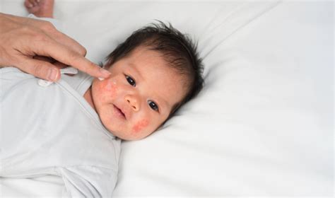 5 tips to help with eczema in babies - Brighter World