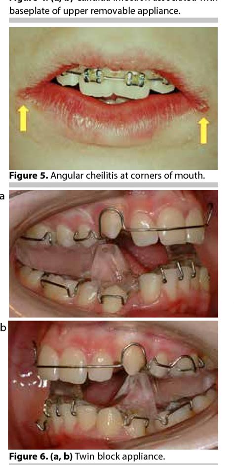 Figure From Emergencies In Orthodontics Part Management Of