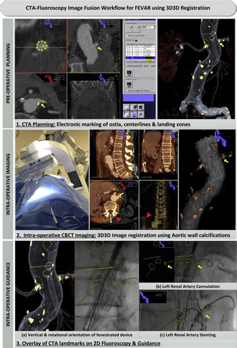 Computed Tomography Angiography Fluoroscopy Image Fusion Allows