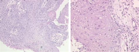 Squamous Cell Carcinoma Histology Ear