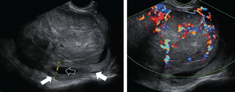 Terms Definitions And Measurements To Describe Sonographic Features Of