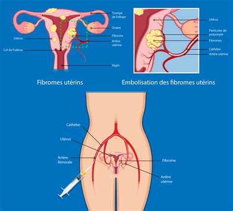 Comment Est Tabli Le Diagnostic Du Fibrome Ut Rin