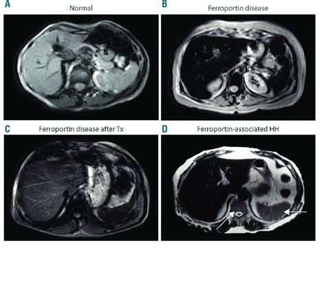 Abdominal magnetic resonance imaging (MRI) pattern of Ferroportin ...