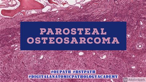 Parosteal Osteosarcoma Youtube