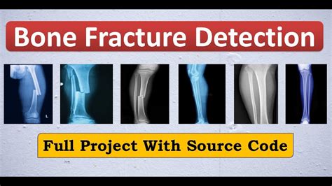 Bone Fracture Detection Using Image Processing Source Code Bone