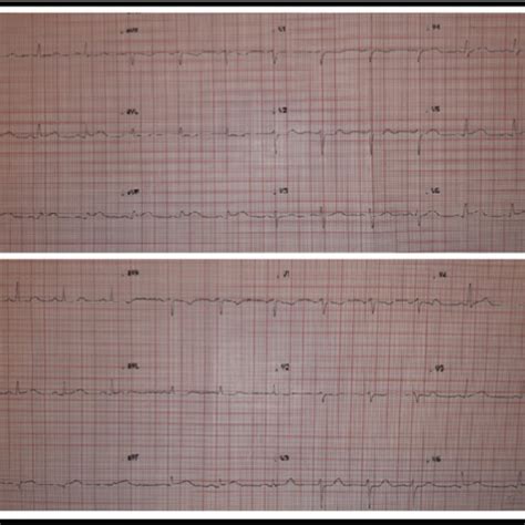 Simultaneous Cardio Cerebral Infarction CCI Causes Type 1 Aortic