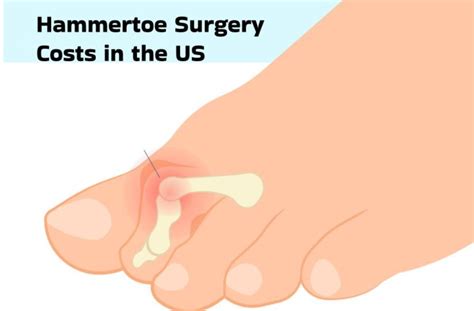 Minimally Invasive Hammertoe Surgery