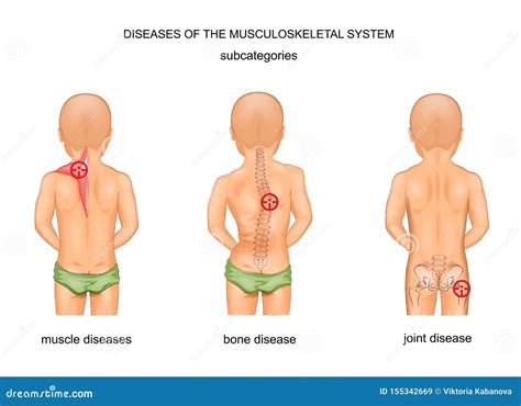 Diseases Of The Musculoskeletal System Cartoon Vector | CartoonDealer ...