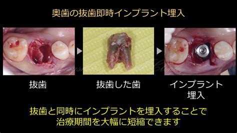 症例集 安心のインプラント治療なら寺嶋歯科医院【大阪・箕面】