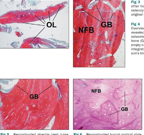 Figure From Gbr And Autogenous Cortical Bone Particulate By Bone