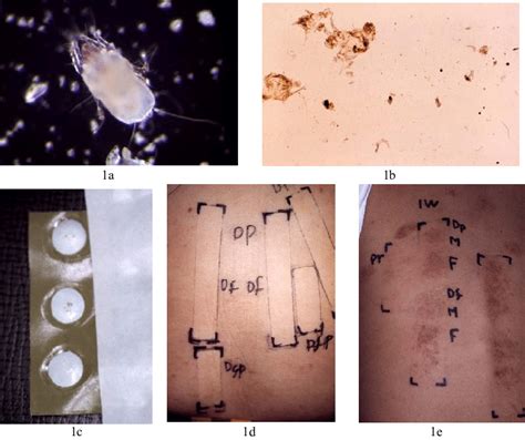 Cultured Live Dermatophagoides Pteronyssinus Dp Female 1a Three