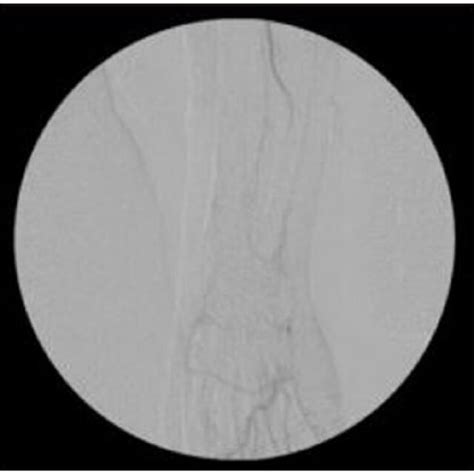 Initial angiogram revealing occlusion of the ulnar artery distally at... | Download Scientific ...