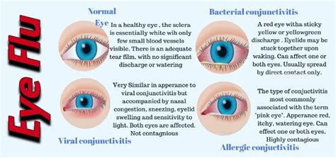 Viral Eye Flu: Causes, Symptoms, Treatment, And Prevention