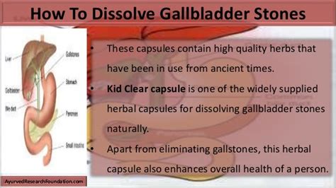 How To Dissolve Gallstones Naturally Dissolve Gallstones Naturally 5 Most Effective Ways