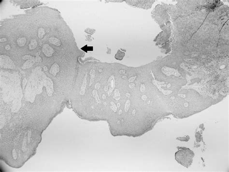 area   epidermis exhibiting acanthosis