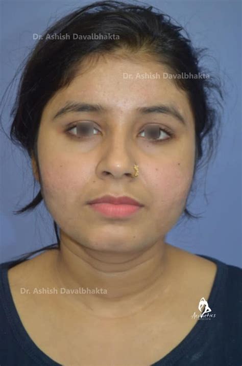 Goodbye To Acne And Scars With Effective Treatments Advanced Aesthetics Pune