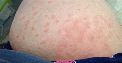 skin rash during pregnancy - pictures, photos