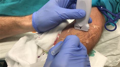 Ultrasound Guided Peripheral IV Insertion Out Of Plane Approach