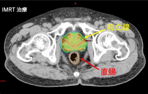 Imrt（強度変調放射線治療）について 関西医科大学附属病院