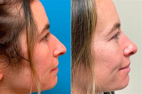 Bulbous Tip Before And After Photos Becker Rhinoplasty Center