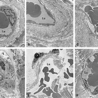 Transmission Electron Microscopic Features Of Vasa Vasorum In Nt Ac