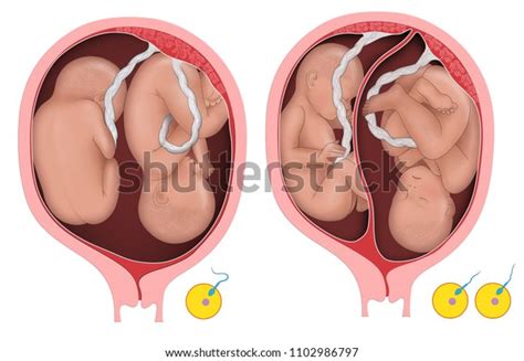 Twins Ultrasound: Over 446 Royalty-Free Licensable Stock Illustrations ...