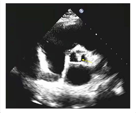 Example Of Echocardiogram Showing Calcification Of The Aortic Valve