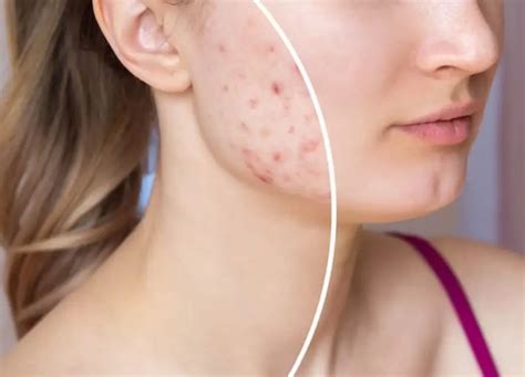 Cicatrizes De Acne Tratamento Em Goi Nia Dermatologista Cinthia