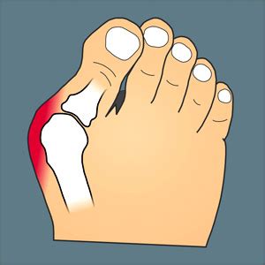 Foot Bunion: Symptoms & Treatment | Study.com