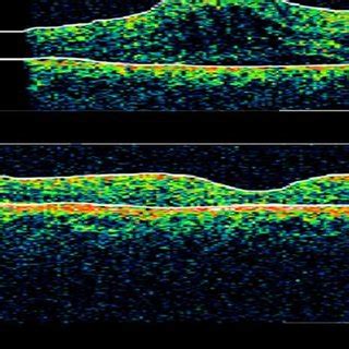 Complete resolution of diabetic macular edema after triamcinolone ...