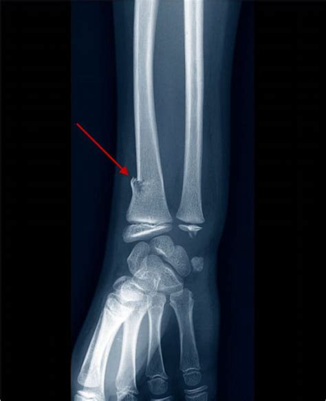 Image Fracture En Bois Vert Du Radius Distal Édition Professionnelle