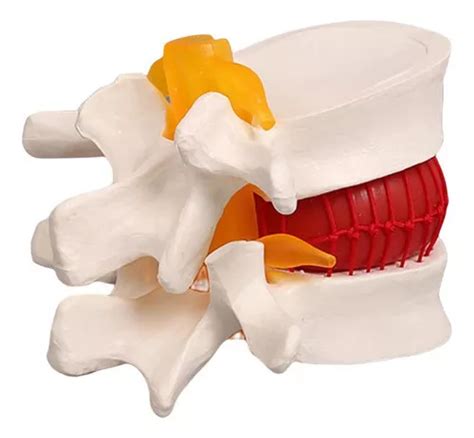 Herramienta Para Modelar Hernias Discales U Mercadolibre