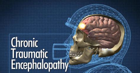 Experimental scan could reveal brain trauma - CBS News