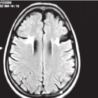 Brain CT scan of Patient 1 showing infarcts in left opercular and... | Download Scientific Diagram