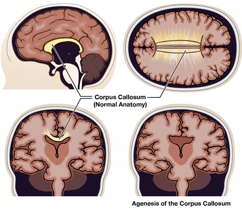 Agenesis of the Corpus Callosum