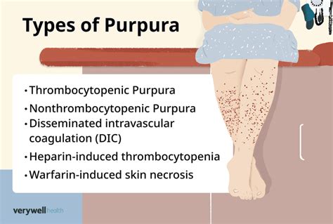 Purpura: Causes, Types, and Treatment