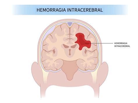 Hemorragia Intraparenquimatosa Vs Hemorragia Subaracnoidea